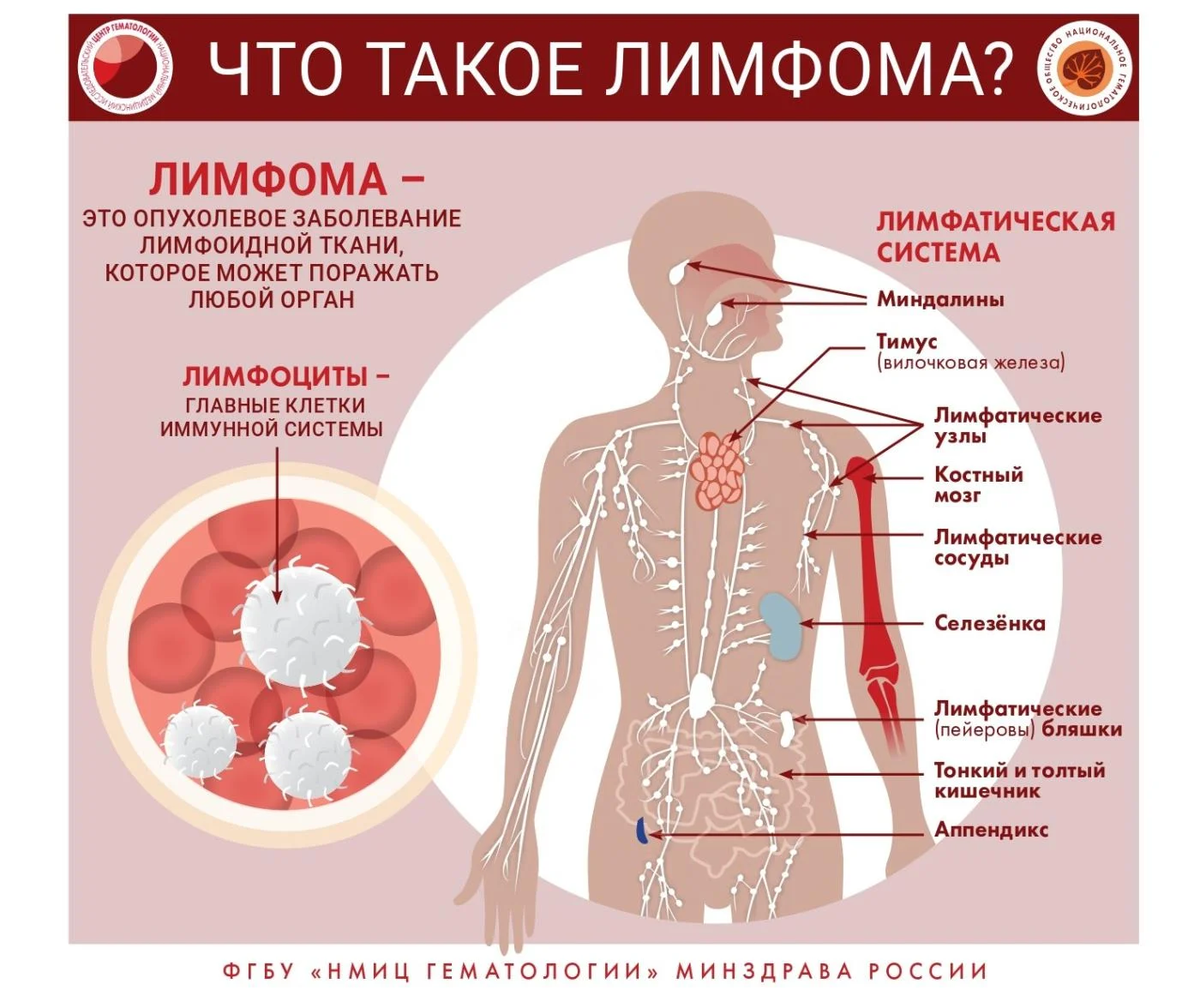 Лимфома: признаки и причины