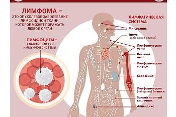 Лимфома: признаки и причины Лимфома: признаки и причины